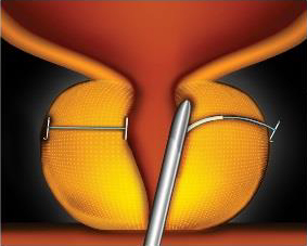 Urology San Diego - UroLift procedure - enlarged prostate